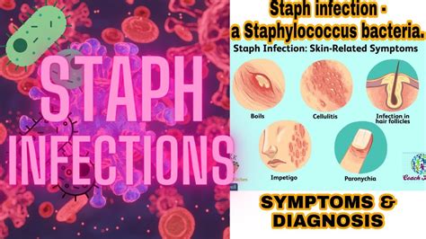 Staph Infection Recurring at Melvin Taylor blog