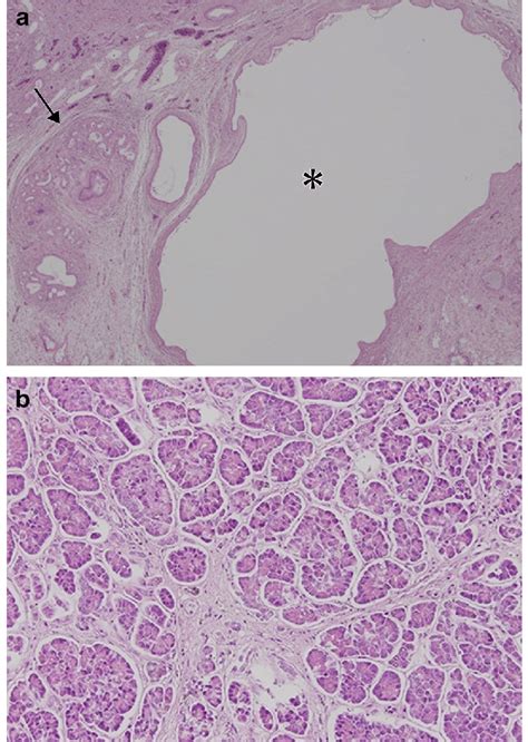 Histopathologic Findings Of Peribiliary Cysts And Chronic Pancreatitis