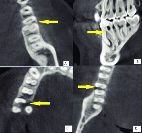 A Axial Cbct Section Showing Initial Furcation Changes In Mandibular