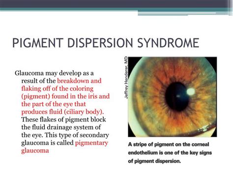 Pigment Dispersion Syndrome Signs