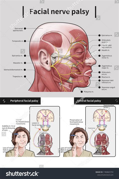 Facial nerve Images, Stock Photos & Vectors | Shutterstock