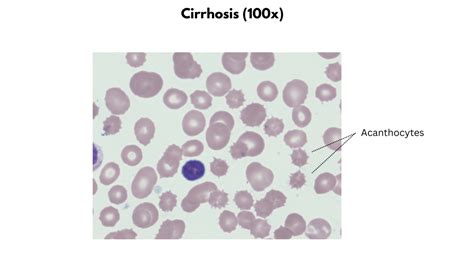 Macrocytic Anemias • The Blood Project