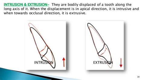 Orthodontic Tooth Movements And Biomechanics