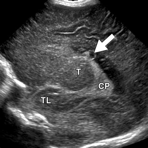 Choroid Plexus Cyst Ultrasound