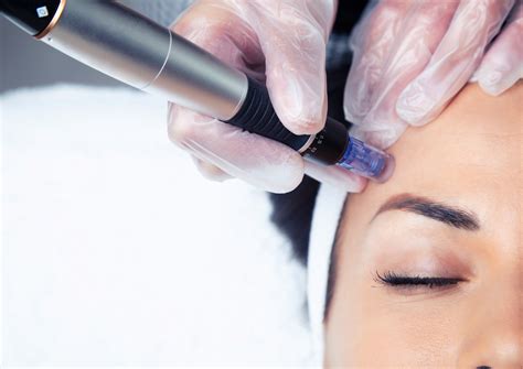 mezoterapia mikroiglowa dermapen vitamin shot katowice pomysl na