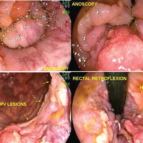 Anal Intraepithelial Neoplasia Squamous Epithelium With Exophytic