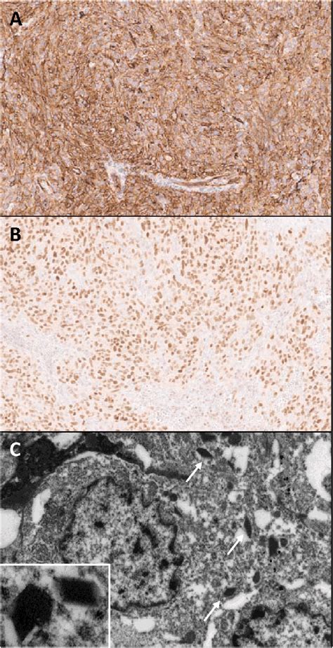 Immunohistochemical Stains Show Tumor Cells Are Diffusely Positive For