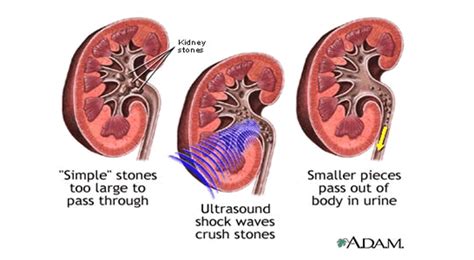 Lithotripsy And Eswl North Georgia Urology Center