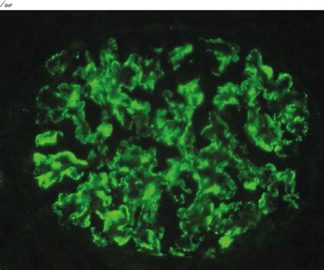 Renal Pathology And Electron Microscopy Dr Lal Pathlabs Blog