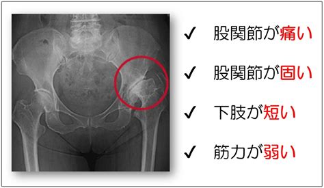 変形性股関節症の症状と治療 おおさかグローバル整形外科病院 大阪市城東区 脊椎、人工関節、スポーツ整形、ペインクリニック 牧ヘルスケアグループ 医療法人 清翠会