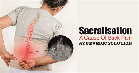 Lumbar Sacralisation: A Cause of Back Pain and its Ayurvedic Treatment