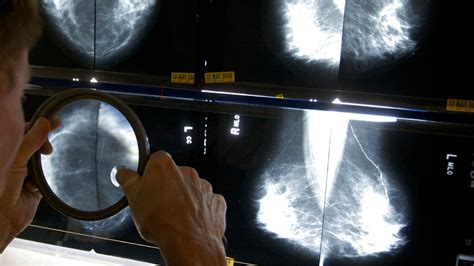 Fda To Require Mammogram Reports Include Breast Density Information Krdo