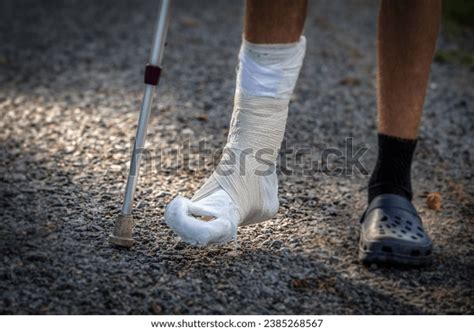 Broken Ankle Leg Cast Leg Splint Stock Photo 2385268567 Shutterstock