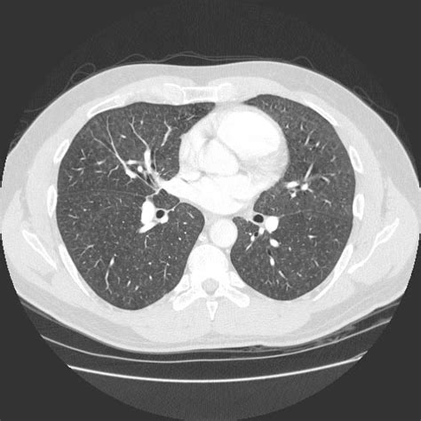 Byssinosis CT - wikidoc