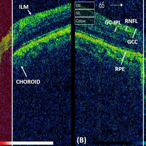 Optic nerve head (ONH) OCT scan depicting (A) healthy and (B ...