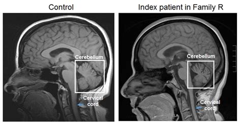 Ataxia Patient Mri Image Eurekalert Science News Releases