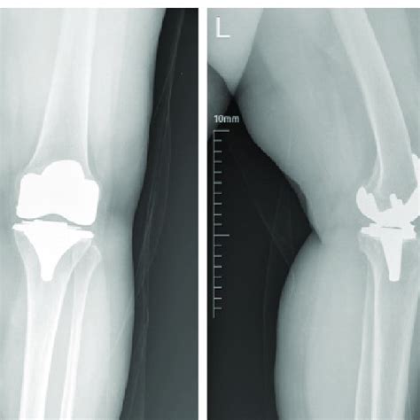 Prosthesis Control With Anteroposterior And Lateral Knee Radiographs Download Scientific Diagram