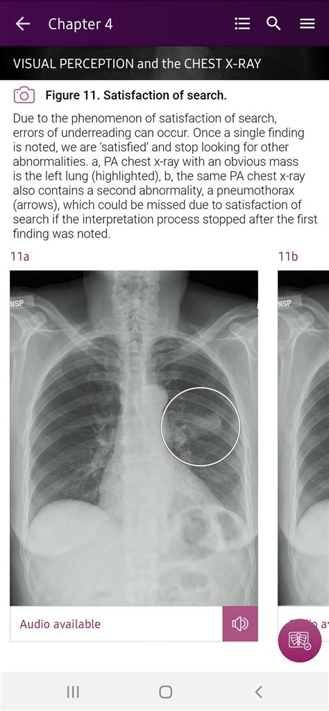 Chest X-Ray Interpretation Latest Version 1.3.3 for Android