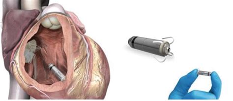 ARRIVA IN SICILIA LA CARDIOCAPSULA IL PIU PICCOLO PACEMAKER AL