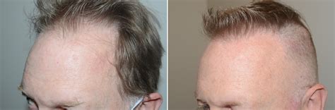 Hair Transplants For Men Photos Miami Fl Patient125258