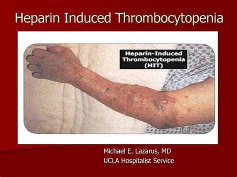 Ppt Heparin Induced Thrombocytopenia Powerpoint Presentation Free Download Id 545327