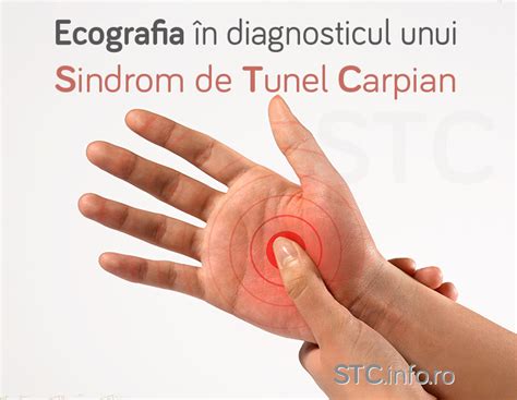 Ecografia In Sindromul De Tunel Carpian Vitta Clinic By Bestetic