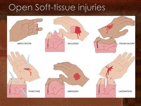 Ppt Bleeding And Soft Tissue Trauma Powerpoint Presentation Free