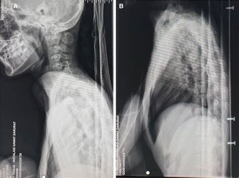 Lateral Plain Radiographs Of Cervical Spine A And Thorax B Showing