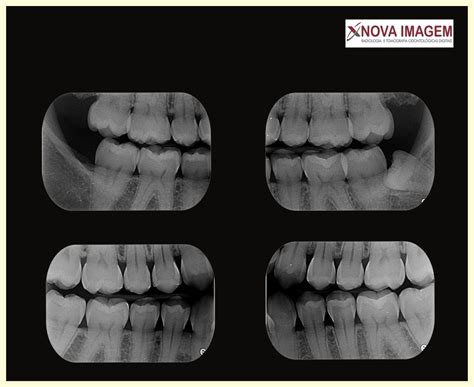 Radiografia Interproximal Bite Wing Nova Imagem RX