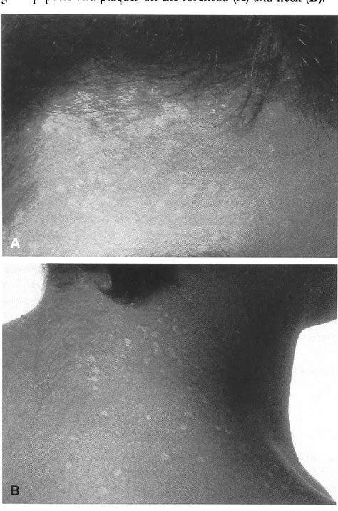 Figure From Epidermodysplasia Verruciformis In Two Half Brothers With