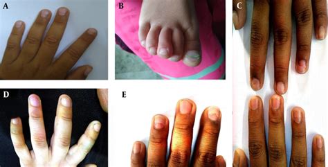 Onychomadesis Secondary To Hand Foot And Mouth Disease