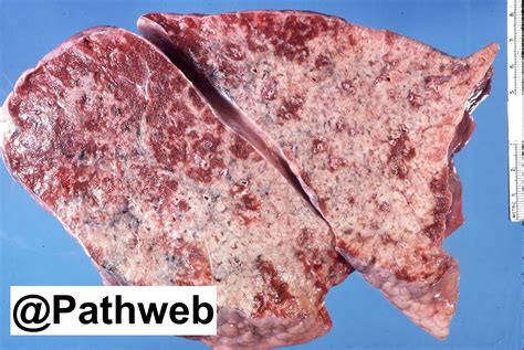 Lung Lobar Pneumonia Nus Pathweb Nus Pathweb