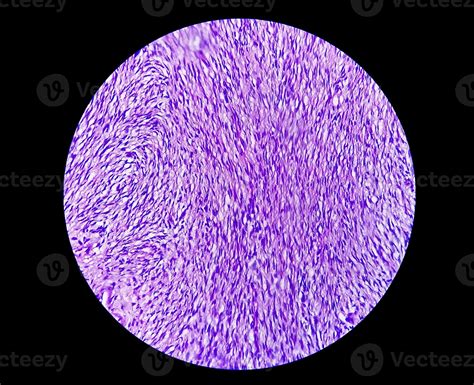 Photomicrograph of a schwannoma, a benign soft tissue tumor of ...