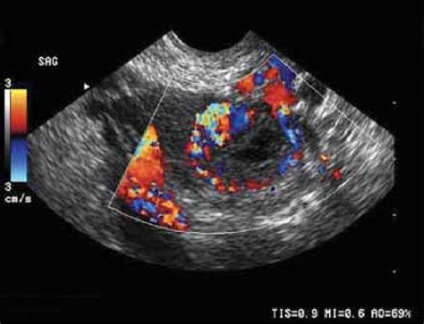 Pdf Role Of Transvaginal Ultrasonography And Colour Doppler In The