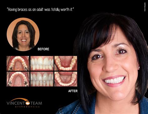 Smiles Gallery Vincent Team Orthodontics