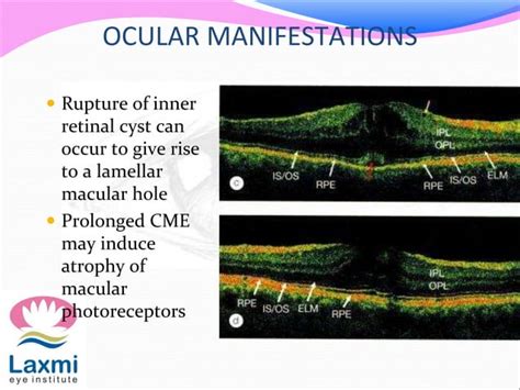 Cystoid macular oedema | PPT