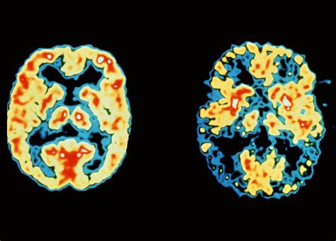 Normal And Alzheimer S Disease Brains Photograph By Dr Robert Friedland