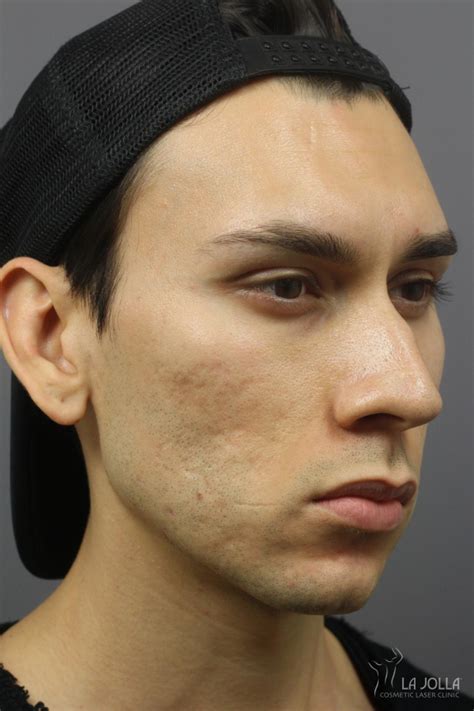 Acne Scars Before After Gallery