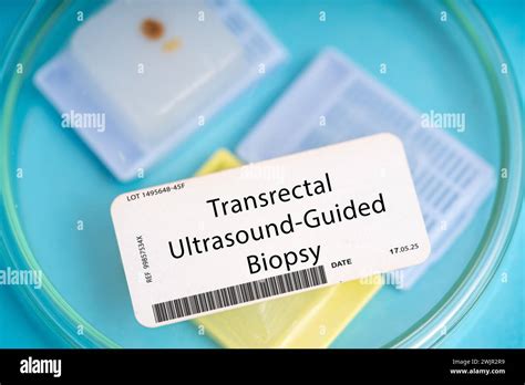 Transrectal Ultrasound Guided Biopsy This Involves The Insertion Of A Needle Into The Prostate