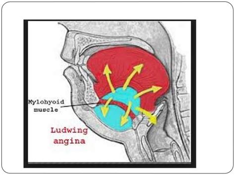 Ludwigs Angina