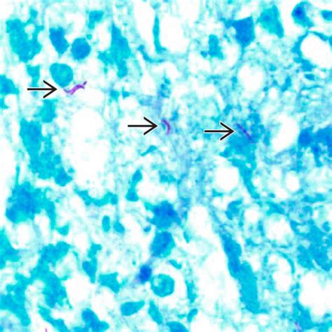 Mycobacterium Tuberculosis Basicmedical Key