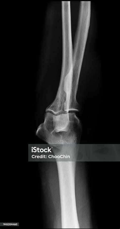 Normal Xray Elbow