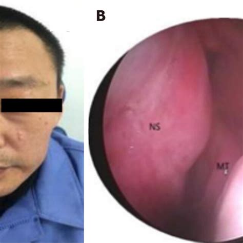 Preoperative Physical Examination A Preoperative Frontal View B