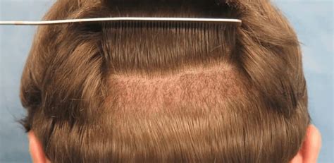 Hair Transplant Success Rate Clinicexpert Services