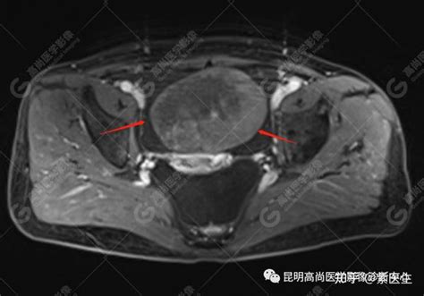 【高尚病例】卵巢纤维瘤一例 知乎