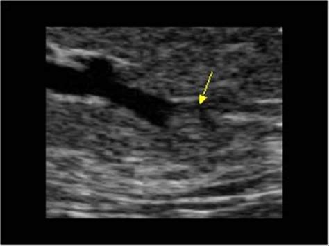 Breast and Axilla | 5.1 Benign lesions : Case 5.1.10 Ductal lesions ...