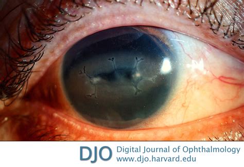 Dendritic Corneal Ulcer