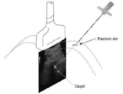 Trajectory Planning In An Ultrasound Guided Needle Insertion Procedure