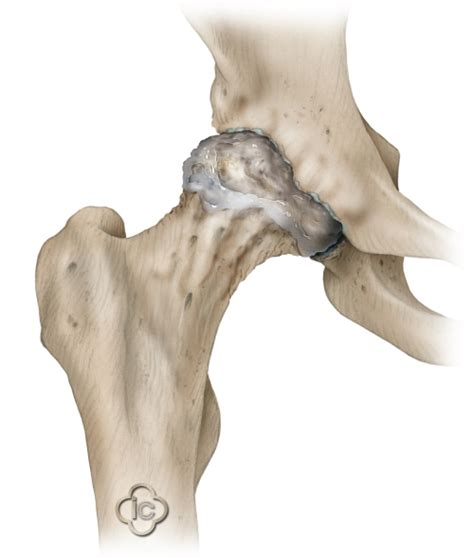 Total Hip Replacement Surgery Hip Prosthesis Joint