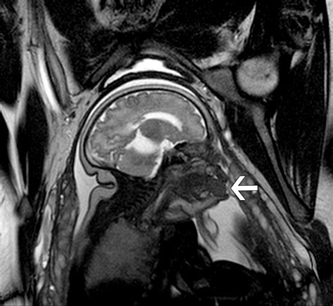 Congenital Oral Masses An Anatomic Approach To Diagnosis Radiographics